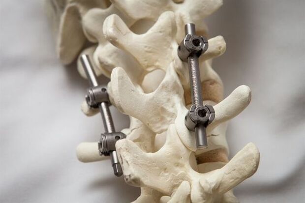 ការជួសជុលឆ្អឹងខ្នង osteochondrosis នៃកញ្ចឹងក