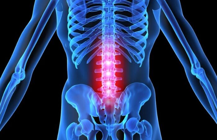 osteochondrosis នៃតំបន់ចង្កេះ