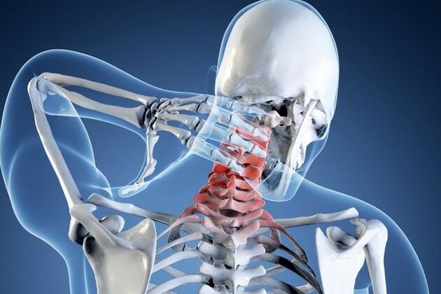osteochondrosis នៃឆ្អឹងខ្នងមាត់ស្បូន